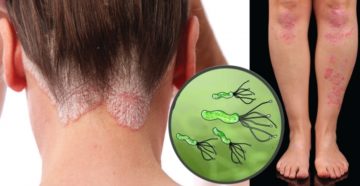 Аллергия и хеликобактер могут быть связаны?