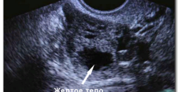 Желтое тело в обоих яичникх