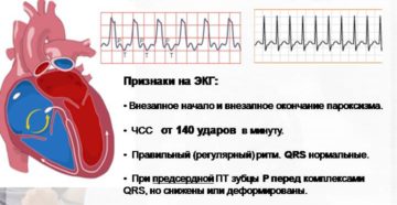 Пароксизмальная тахикардия