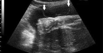 Примеси в водах при беременности Примеси в водах при беременности