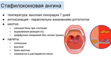 Насколько опасен тонзиллит, вызванный золотистым стафилоккоком?