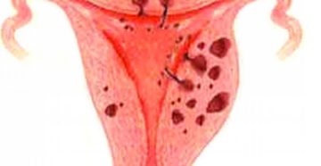 Диффузные изменения шейки матки