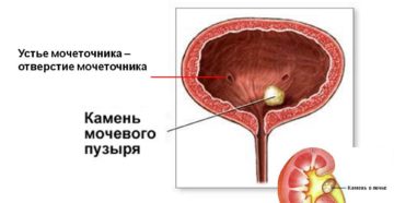 Камень в устье мочеточника