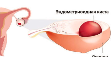 Постоянные боли, эндометриоидная? Киста яичника