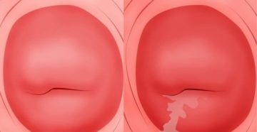 Покраснения шейки матки Покраснения шейки матки