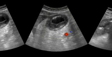 На УЗИ желудка обнаружили уплотнение стенок желудка, что это?