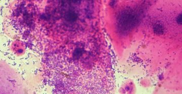 Гарднерелла с кандидозом. Если лечение не помогает Гарднерелла с кандидозом. Если лечение не помогает