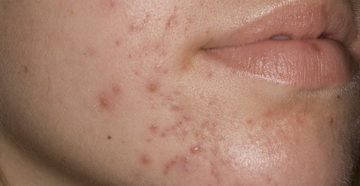 Прыщи на лице на 6 день приема Утрожестана Прыщи на лице на 6 день приема Утрожестана