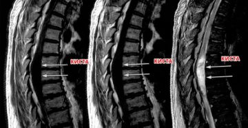 Периневральная киста позвоночника