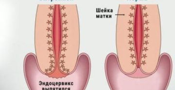 Эктропион шейки матки