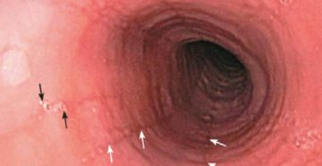 Царапина пищевода?