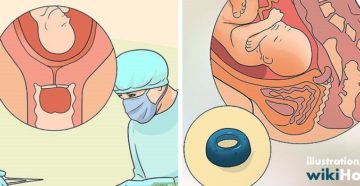 Пессарий при тонусе и укорочённой шейки Пессарий при тонусе и укорочённой шейки