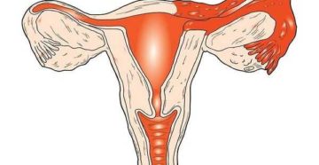Хронический левосторонний сальпингит Хронический левосторонний сальпингит