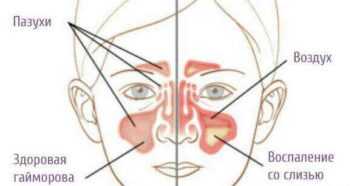 Высокий СОЭ и воспаление придаточных пазух носа Высокий СОЭ и воспаление придаточных пазух носа