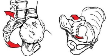 Естественные роды и перелом копчика