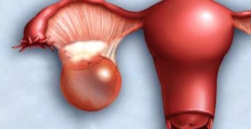 Киста левого яичника 6см