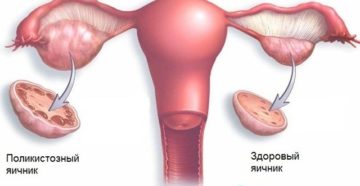 Киста яичника у подростка