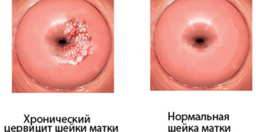 Половая жизнь при лечении цервицита Половая жизнь при лечении цервицита