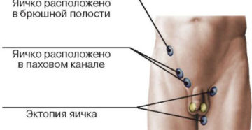 Не втягивается левое яичко