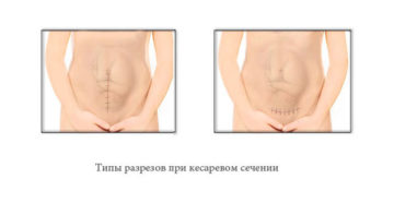 Беременность спустя 7 месяцев после кесарева возможна?