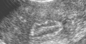 Хронический эндометрит и кальцинаты на повторном узи Хронический эндометрит и кальцинаты на повторном узи