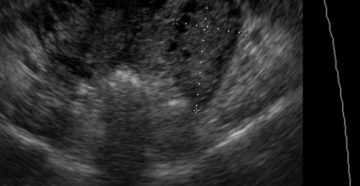 Кальцинаты миометрия