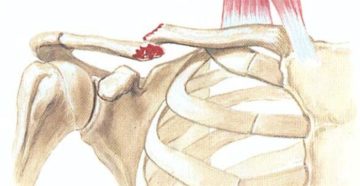 Перелом ключицы не срастается уже 2 месяца, помогите!
