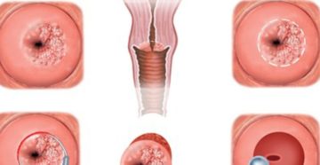 Кровотечение после прижигания эрозии Кровотечение после прижигания эрозии