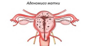 Аденомиоз матки консультация
