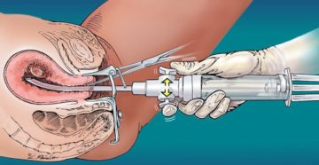Секс после вакуумной аспирации