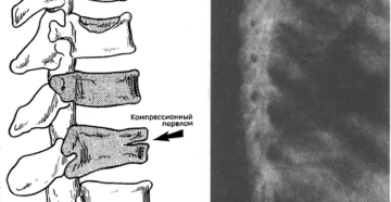 Перелом позвонка s5