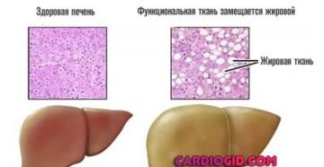 Жировой гепатоз, повышен ггтп