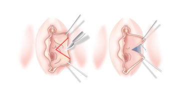 Пластика половых губ, лабиопластика