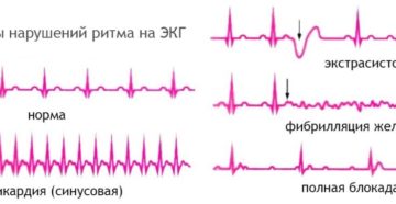 ЭКГ может ли не обнаружить заболевания сердца?