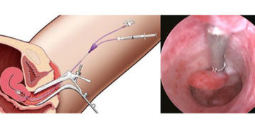 Полип эндометрия удалять ли нерожавшей?