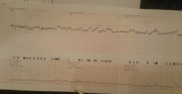 Преждевременное старение плаценты, расшифровка КТГ