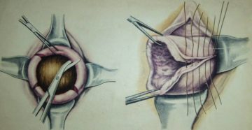 После ушивания шейки