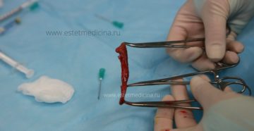 Осложнение лабиопластики