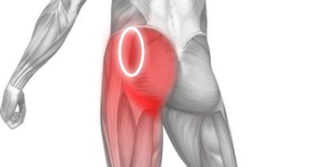 Острая боль в левой ягодице после тренировки