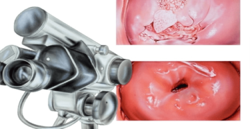 Осмотр на кресле зеркалом при беременности