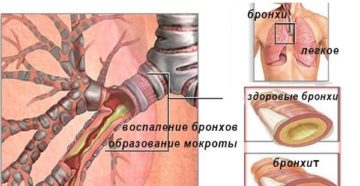 Слизистые пробки в s8 легкого