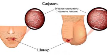 Язвочка на половом члене, признаки сифилиса