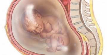 Многоводие на 34 неделе беременности