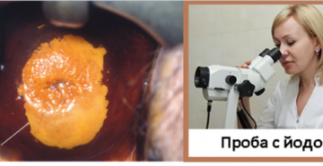 Кольпоскопия, йод-негативная зона