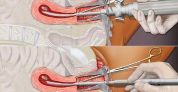Чистка после замершей беременности