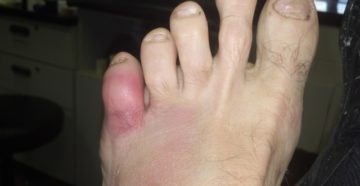 Мозоль на ноге посинела, опухла