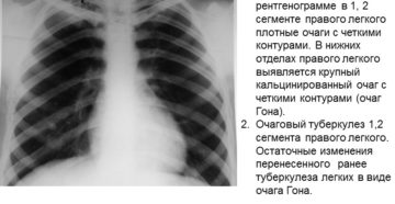 Плотные очаги в легком