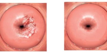 Есть ли улучшения после лечения шейки матки