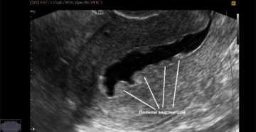 Полип эндометрия. На какой день цикла делать УЗИ