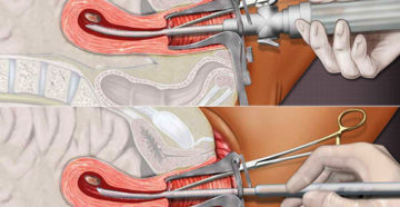 Плохое самочувствие после вакуум аспирации